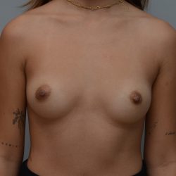 Breast Augmentation Before & After Patient #3588