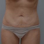 Abdominoplasty Before & After Patient #3611