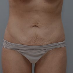Abdominoplasty Before & After Patient #3611