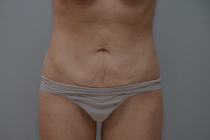 Abdominoplasty Before & After Patient #3611