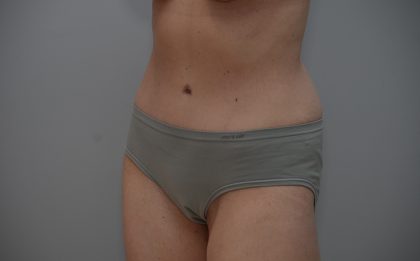 Abdominoplasty Before & After Patient #3611