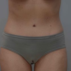 Abdominoplasty Before & After Patient #3611