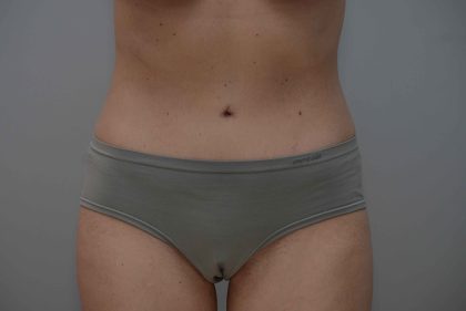 Abdominoplasty Before & After Patient #3611