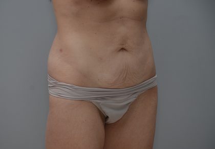 Abdominoplasty Before & After Patient #3611
