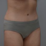 Abdominoplasty Before & After Patient #3611