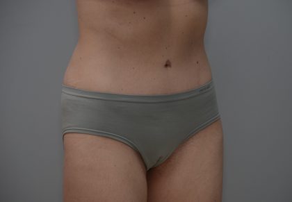 Abdominoplasty Before & After Patient #3611