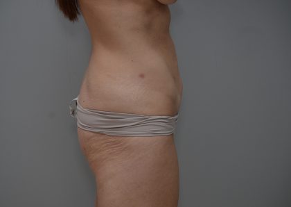 Abdominoplasty Before & After Patient #3611