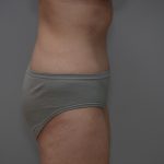 Abdominoplasty Before & After Patient #3611