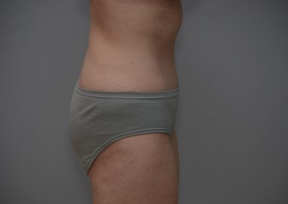 Abdominoplasty Before & After Patient #3611