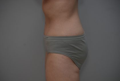 Abdominoplasty Before & After Patient #3611