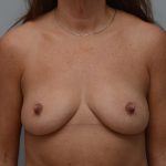 Breast Augmentation Before & After Patient #3622