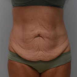 Abdominoplasty Before & After Patient #3633
