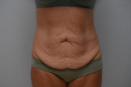 Abdominoplasty Before & After Patient #3633