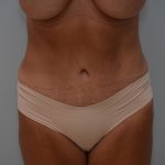 Abdominoplasty Before & After Patient #3633