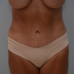 Abdominoplasty Before & After Patient #3633