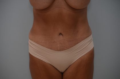 Abdominoplasty Before & After Patient #3633