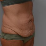 Abdominoplasty Before & After Patient #3633