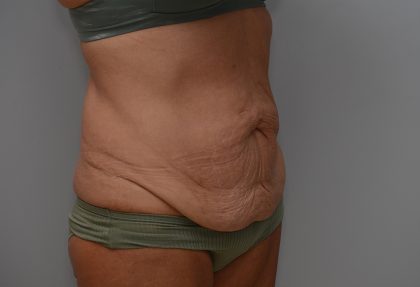 Abdominoplasty Before & After Patient #3633