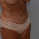 Abdominoplasty Before & After Patient #3633