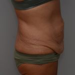 Abdominoplasty Before & After Patient #3633