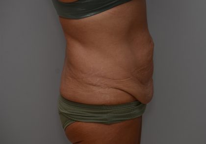 Abdominoplasty Before & After Patient #3633