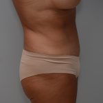 Abdominoplasty Before & After Patient #3633