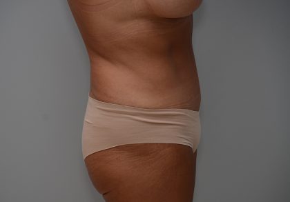 Abdominoplasty Before & After Patient #3633