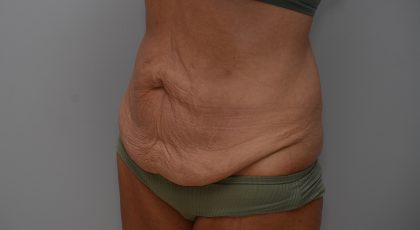 Abdominoplasty Before & After Patient #3633