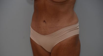 Abdominoplasty Before & After Patient #3633