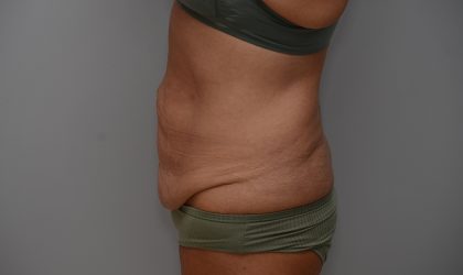 Abdominoplasty Before & After Patient #3633