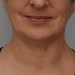 Facetite Before & After Patient #3645