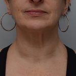 Facetite Before & After Patient #3645