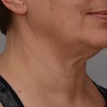 Facetite Before & After Patient #3645