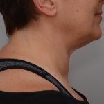 Facetite Before & After Patient #3645