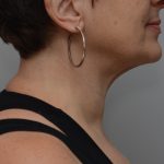 Facetite Before & After Patient #3645