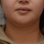 Neck Liposuction Before & After Patient #3656