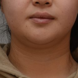 Neck Liposuction Before & After Patient #3656