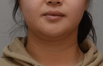 Neck Liposuction Before & After Patient #3656
