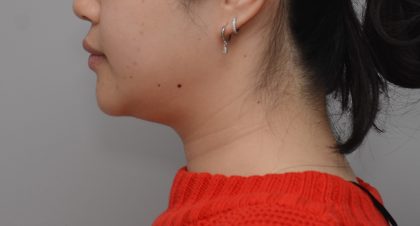 Neck Liposuction Before & After Patient #3656