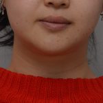 Neck Liposuction Before & After Patient #3656