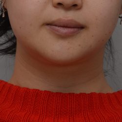 Neck Liposuction Before & After Patient #3656