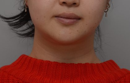 Neck Liposuction Before & After Patient #3656