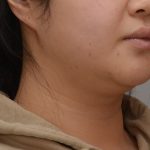 Neck Liposuction Before & After Patient #3656