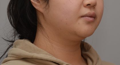 Neck Liposuction Before & After Patient #3656