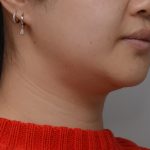 Neck Liposuction Before & After Patient #3656
