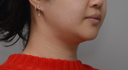 Neck Liposuction Before & After Patient #3656