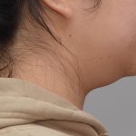 Neck Liposuction Before & After Patient #3656