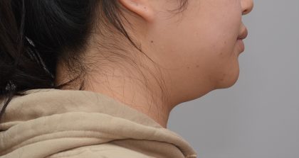 Neck Liposuction Before & After Patient #3656