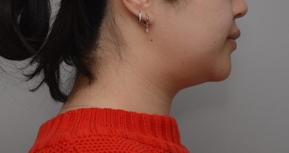 Neck Liposuction Before & After Patient #3656