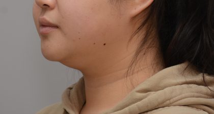 Neck Liposuction Before & After Patient #3656